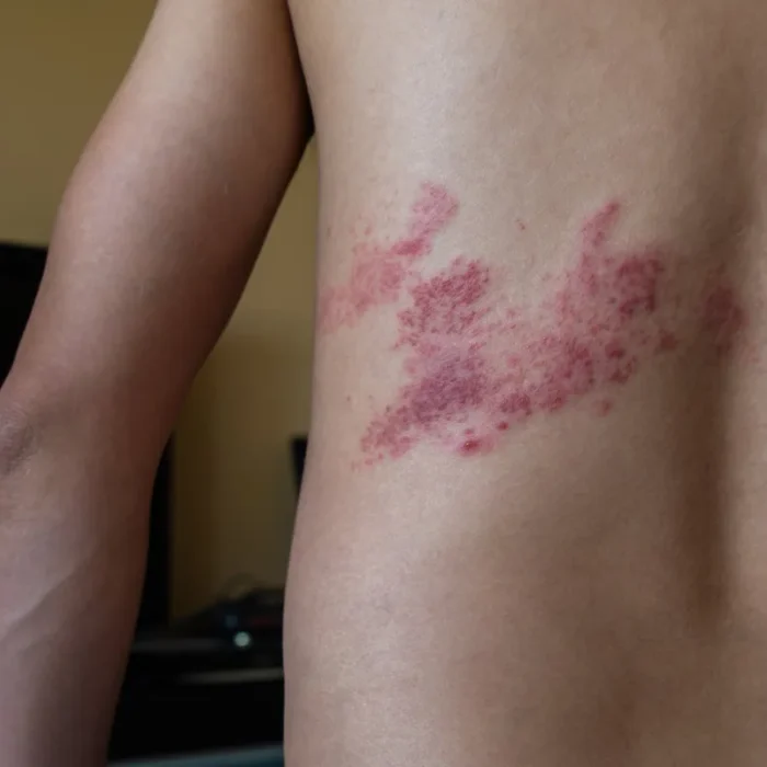 Shingles Diagnosis in Burleson, TX
