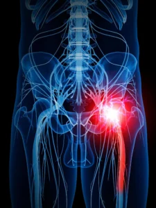 Sciatica pain relief - IPS DFW