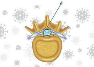 Steroid Injection Therapy